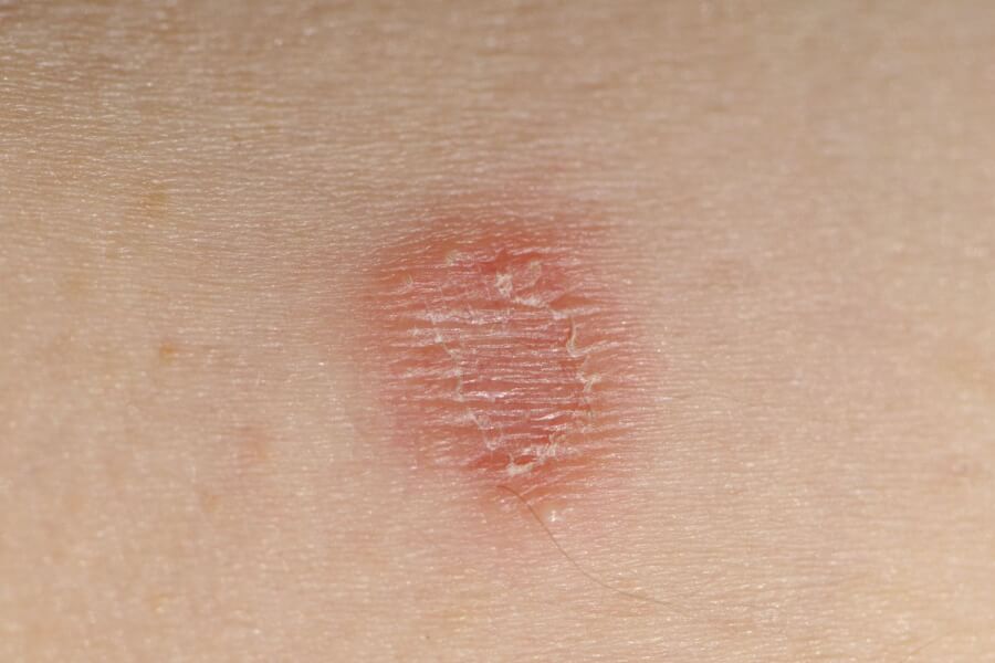 Вірусні інфекції шкіри