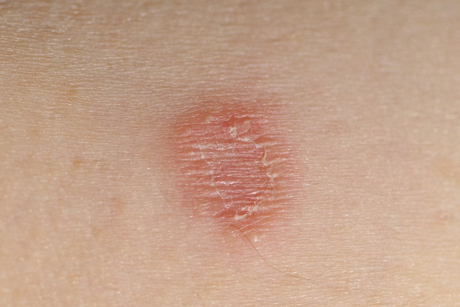 Вірусні інфекції шкіри