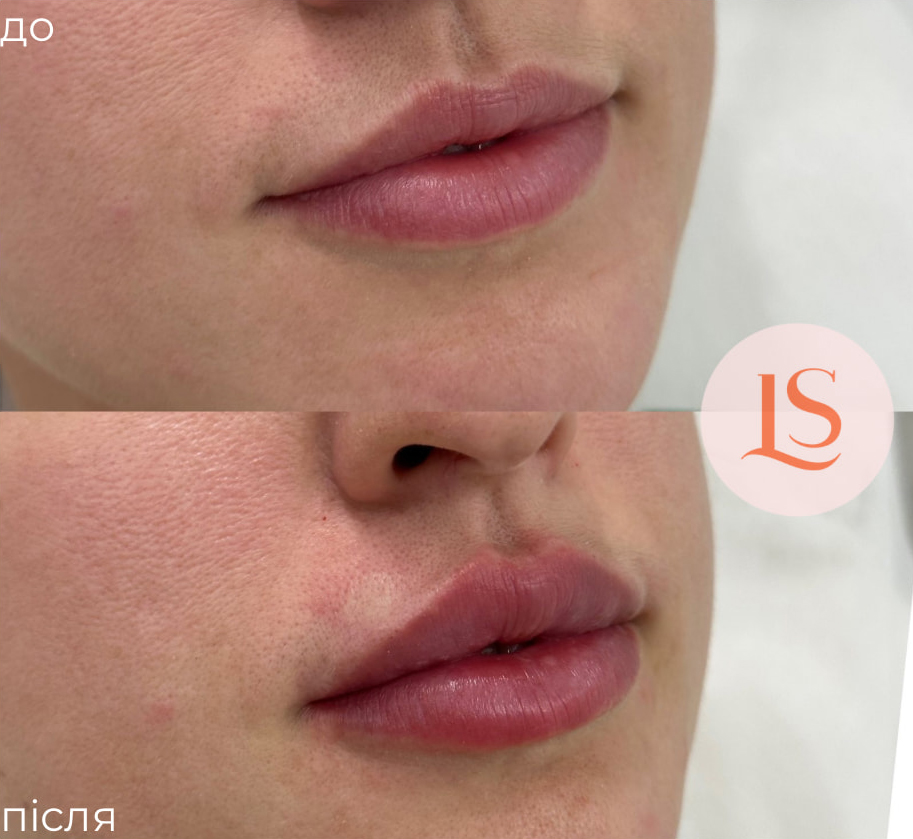 Збільшення губ-_9 Збільшення губ-_9