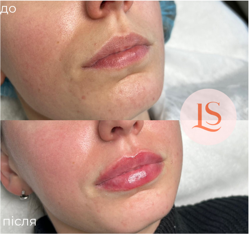 Збільшення губ-_10 Збільшення губ-_10