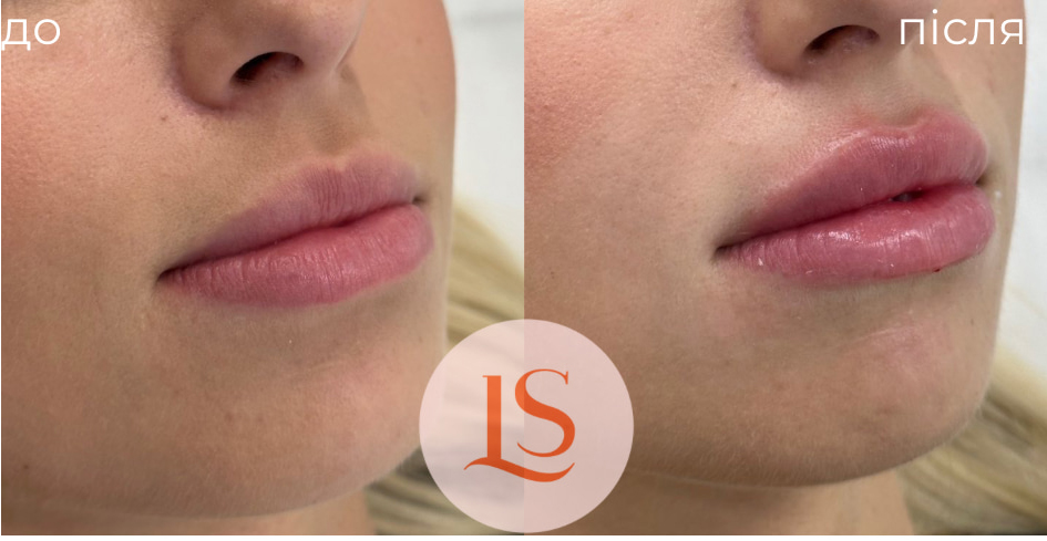 Збільшення губ-_10 Збільшення губ-_10