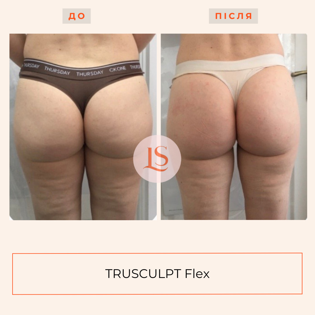 Корекція фігури на апараті TRUSCULPT Flex-_12