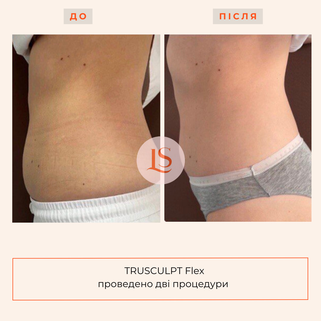 Корекція фігури на апараті TRUSCULPT Flex-_9