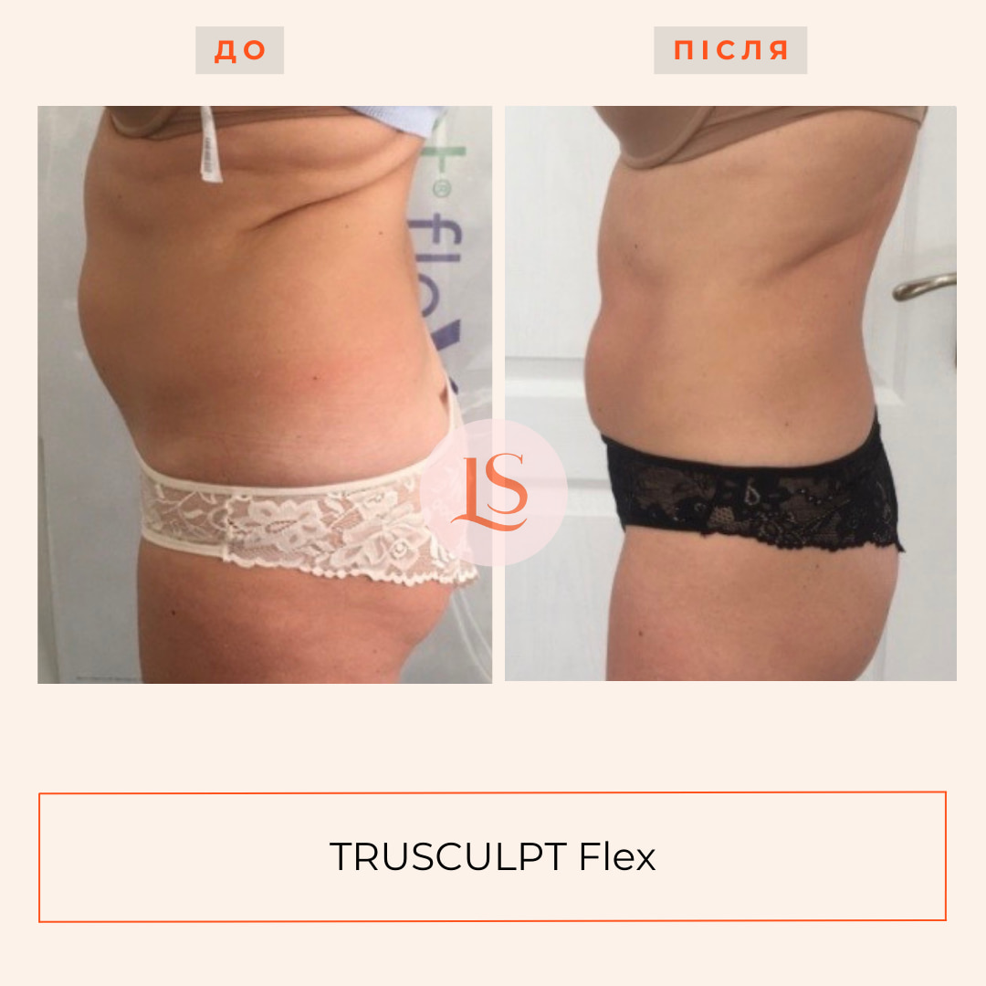 Корекція фігури на апараті TRUSCULPT Flex-_10