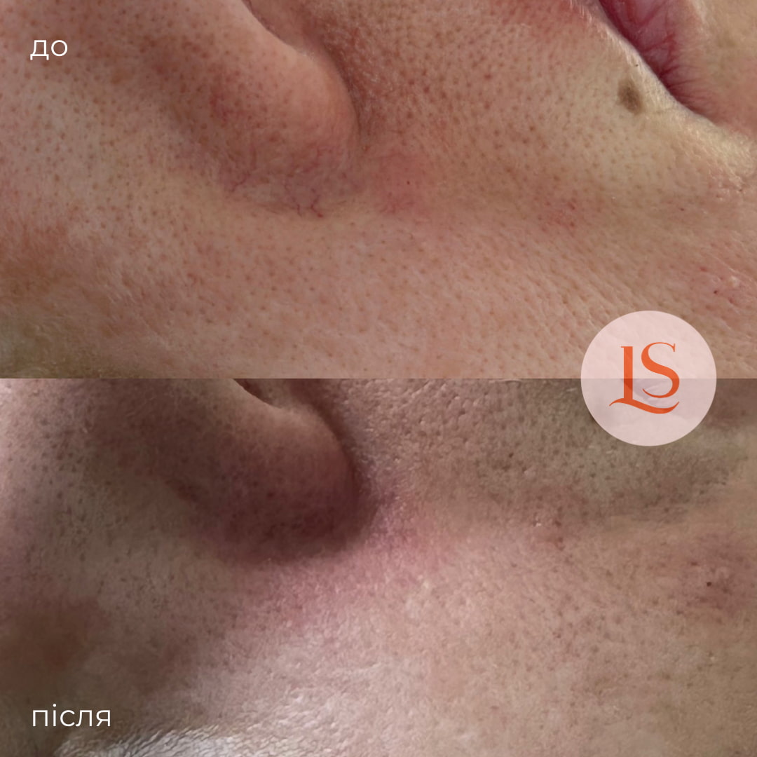 Лазерне видалення судин у Львові-_4