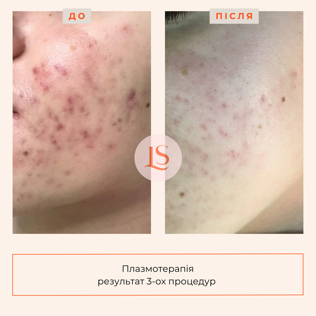 Плазмотерапія Endoret PRGF-_3