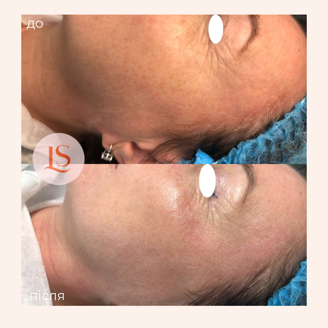 Гідропілінг-_8