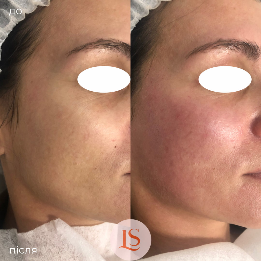 Гідропілінг-_9