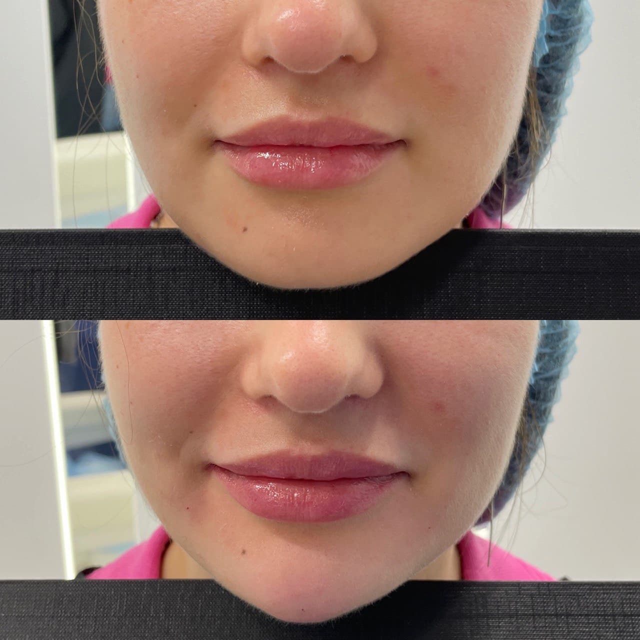 Ін'єкційна контурна пластика-_10