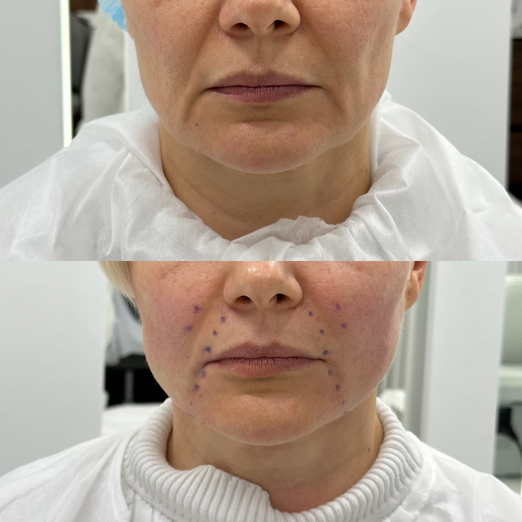 Підтяжка обличчя нитками APTOS-_1