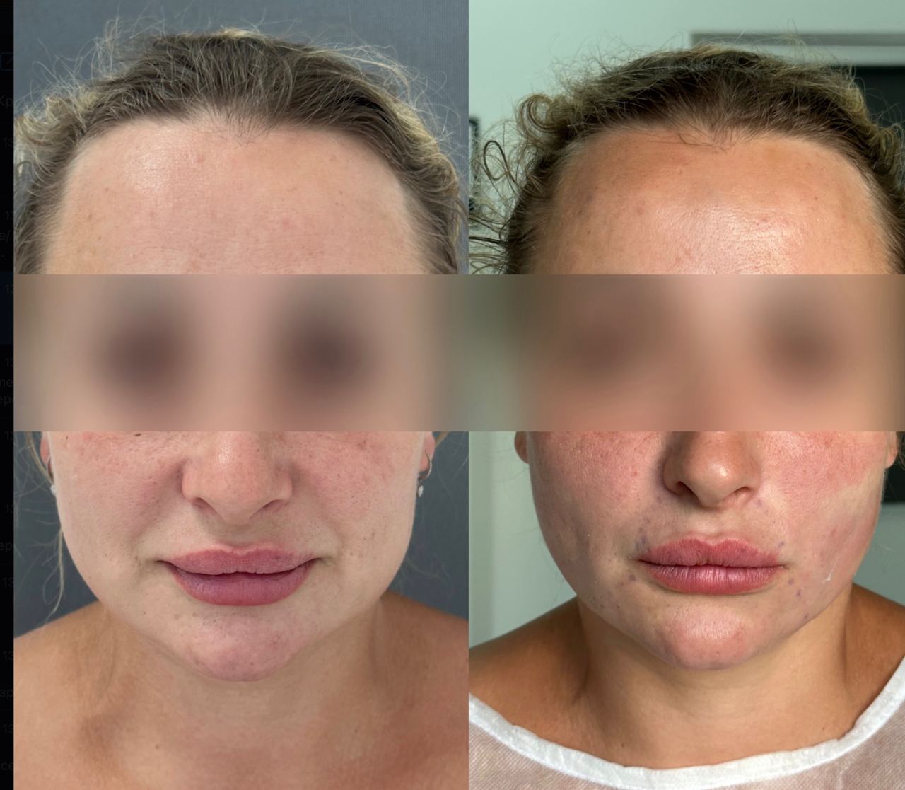 Підтяжка обличчя нитками APTOS-_5