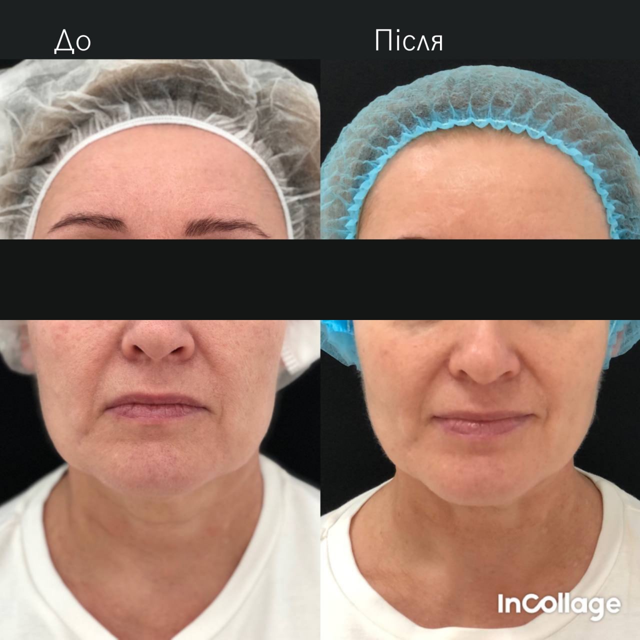 Ліфтинг обличчя Agnes-_4