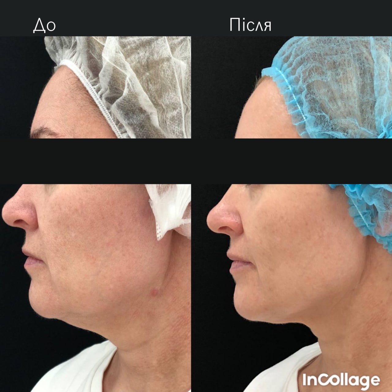 Ліфтинг обличчя Agnes-_5