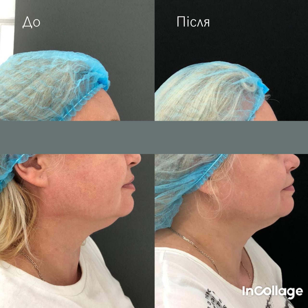 Ліфтинг обличчя Agnes-_7