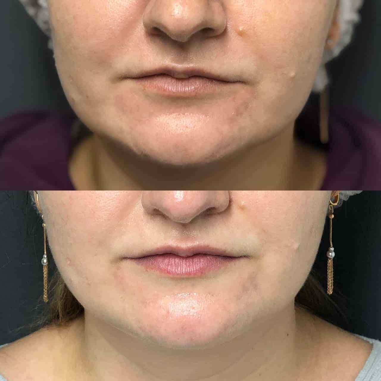 Мікроголковий RF ліфтинг EndyMed-_5