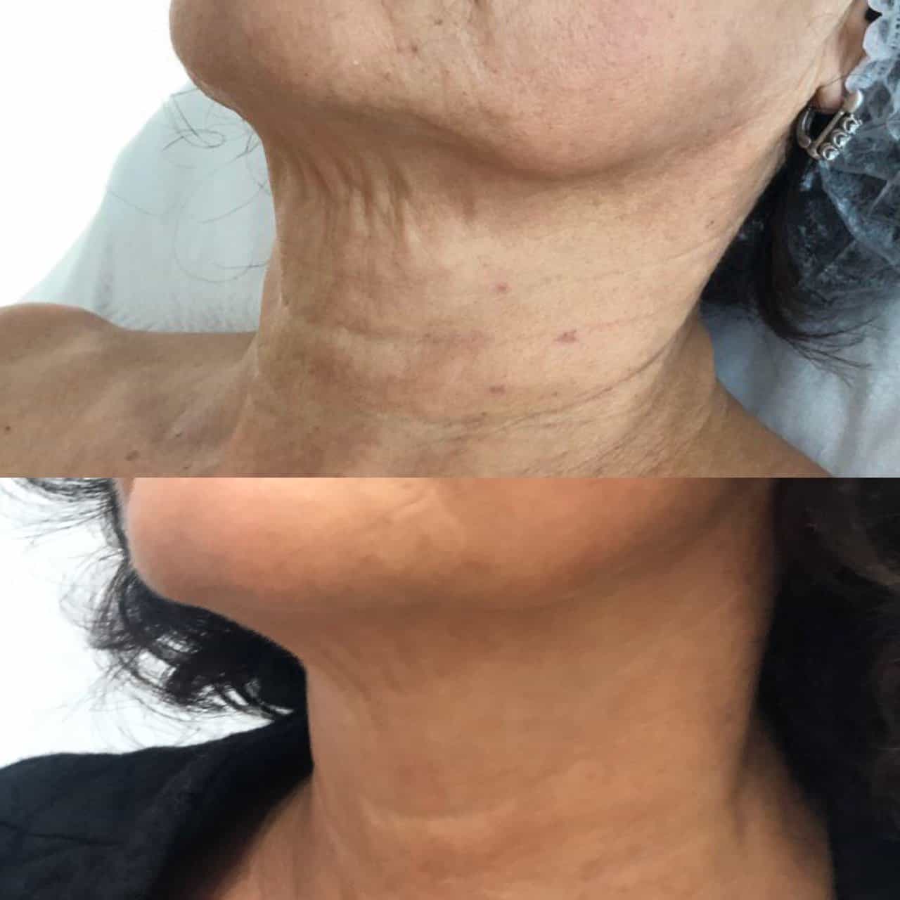 Мікроголковий RF ліфтинг EndyMed-_4